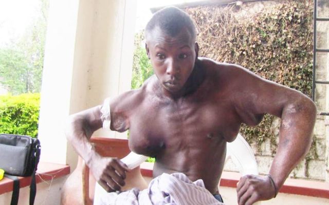 Kenyan Man with Abnormal Swelling in Chest, Arms Seeks Help to Get Live-Saving Surgery  