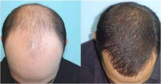 Hair Transplant Clinic Opened in Nairobi