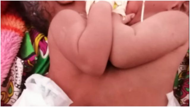 Kenyan Teenager Gives Birth to Conjoined Twins at Lenmek Hospital