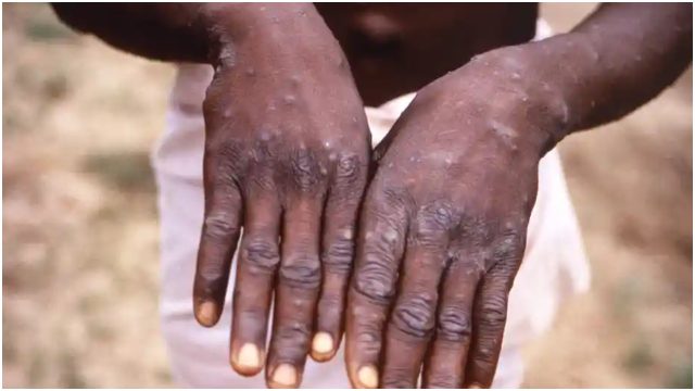 Health Ministry Says No Case of Monkeypox Recorded in Kenya