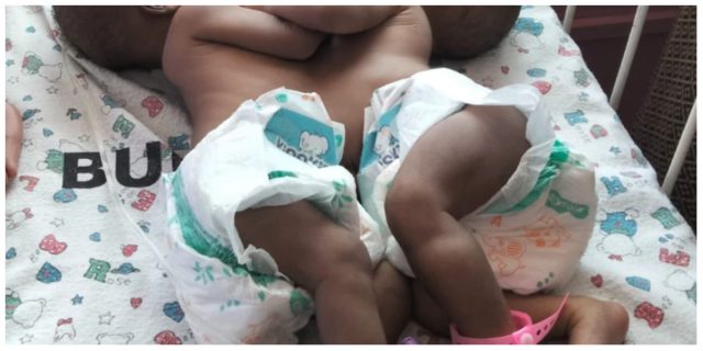 Kenyan Woman Appeals for Help After Giving Birth to Conjoined Twins