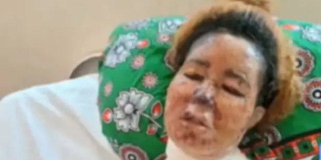 Mombasa Woman Fights for Her Life After Boyfriend Scalds Her Face with Boiling Oil 